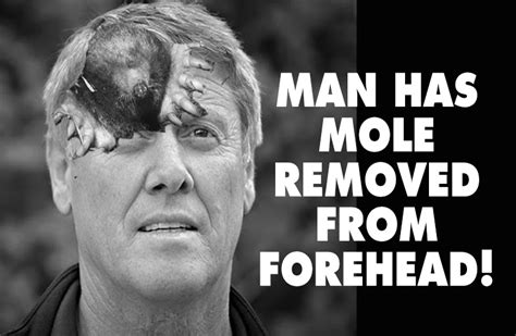 MAN HAS MOLE REMOVED FROM FOREHEAD - Weekly World News