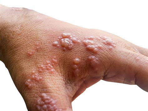 Trypophobia Skin Causes