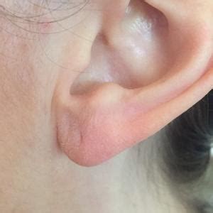 All about earlobes!: West End Facial Plastic Surgery: Facial Plastic ...