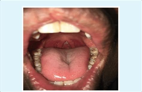 Absent uvula in oral cavity, parapharyngeal arch visible. | Download ...