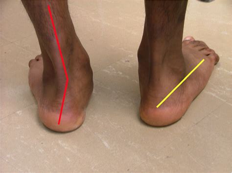 Treating Deformities in Athletes: Pes Cavus and Pes Planus | Podiatry Today