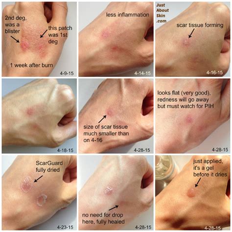 Burn Scar Treatment Case Study - How I Treated A Burn Scar With ...