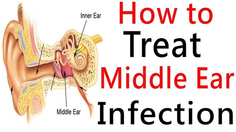 Middle Ear Infection & Middle Ear Effusion - Causes & Treatment