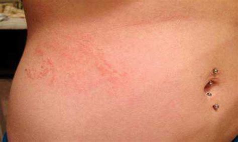 How To Recognize Scabies Rash In 2021 Scabies Rash Scabies Scabies ...