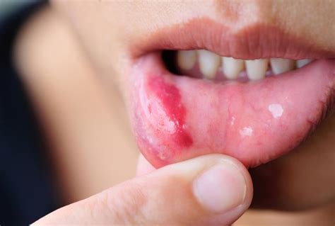 Mouth ulcers | FindATopDoc