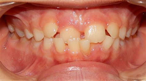 Anterior crossbite treatment in a child - Platinum Orthodontics