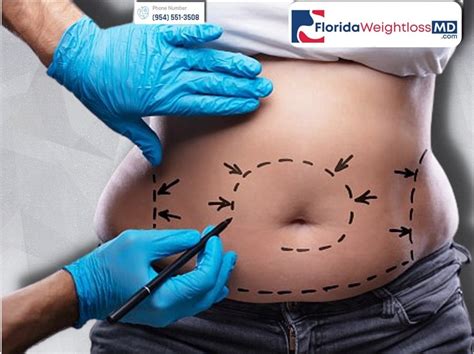 Best Tummy Tuck Surgeon in Miami-Dade County - Abdominoplasty doctors