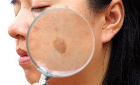 Common Causes of Melasma and What You Can Do About It: Rapaport ...