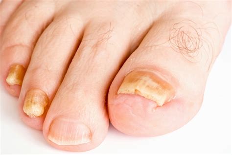 Onychomycosis: Types of Nail Fungus, Causes, and Symptoms | Nailpro