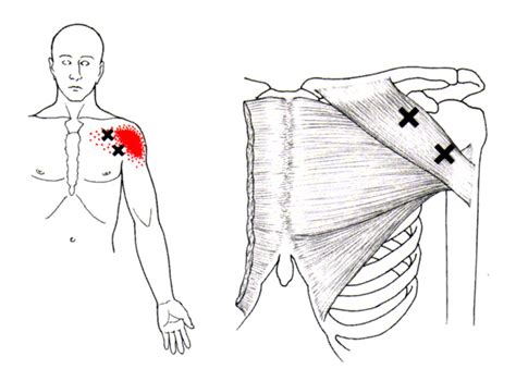 Pectoralis Major | The Trigger Point & Referred Pain Guide