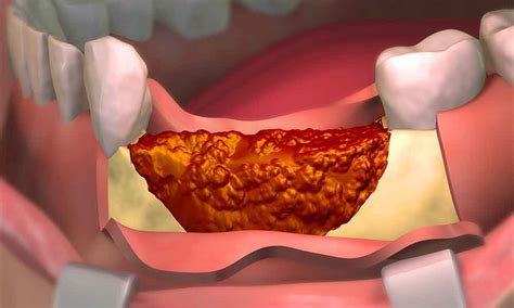 What Are The Signs Of A Failed Dental Bone Graft? - IMPLANT PERIO CENTER