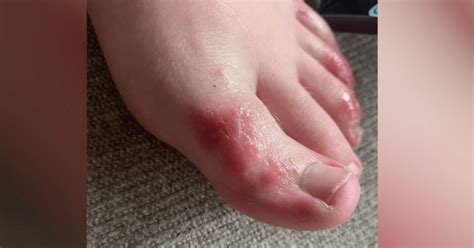 COVID toes: Mysterious rash can affect feet in patients with ...