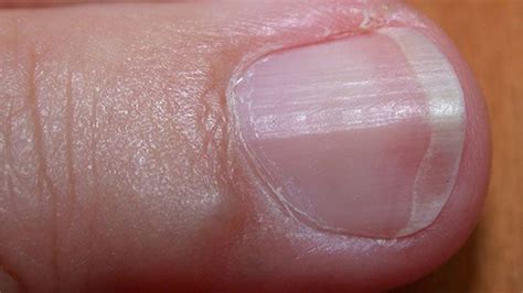 What Causes White Lines On Toenails