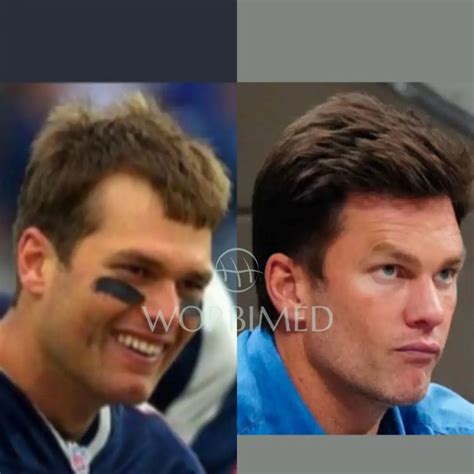 Tom Brady Hair Transplant l Before and After