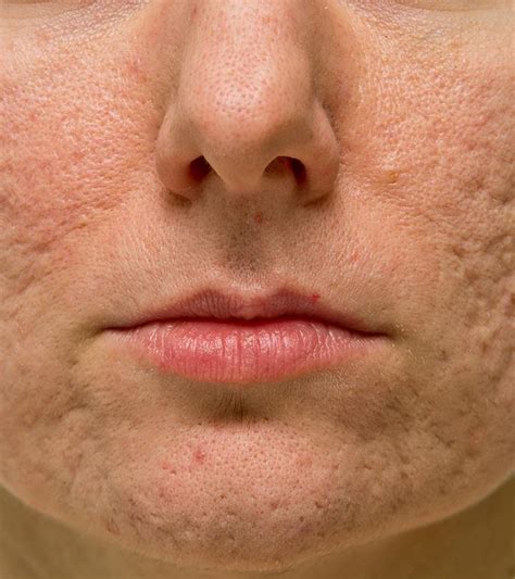 Different Types Of Atrophic Acne Scars And How To Treat Them