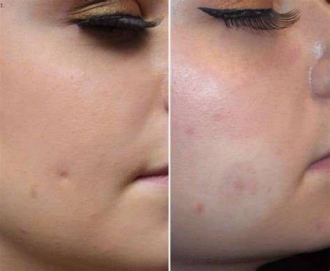 Cheek piercing scars – Prnso