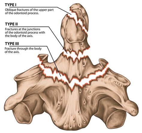 Image result for odontoid process | Foto, Anatomía, Ilustraciones