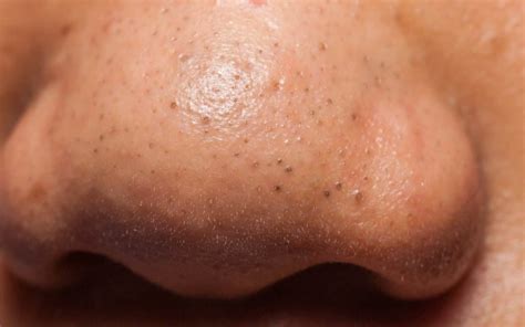 Blackheads on Nose: Causes, Remedies & Prevention Tips | The Derm Spot