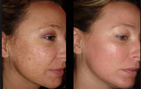 Post-inflammatory Hyperpigmentation is a skin condition in which the ...