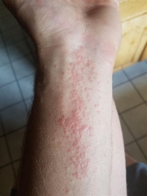 Have a persistent rash on my left forearm. Any ideas or should I visit ...