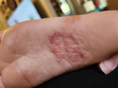 Peeling skin on toddlers foot : r/Dermatology