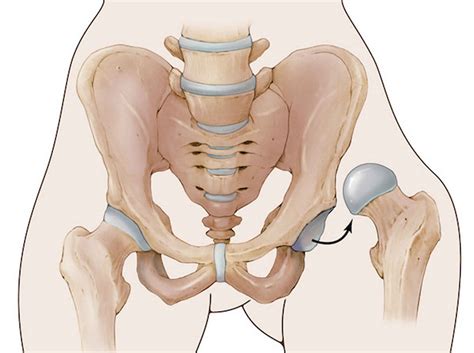 Hip dislocation causes, symptoms, diagnosis, treatment & recovery