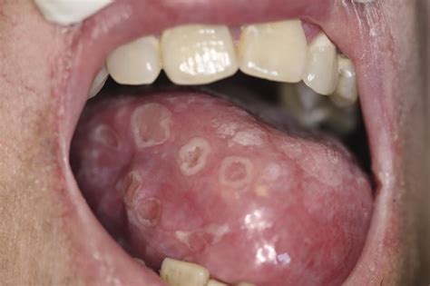 Syphilis in the oral cavity: on the lips and tongue - manifestations ...