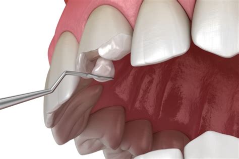 5 Tips on Treating a Broken Tooth - Oak Tree Dental McLean Virginia