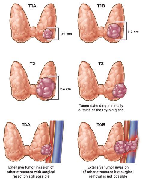 Initial Staging & Response to Therapy ‣ Differentiated Thyroid Cancer