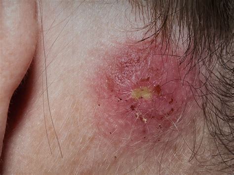 Staph infection: Types, symptoms, causes, treatments - Medical News Today