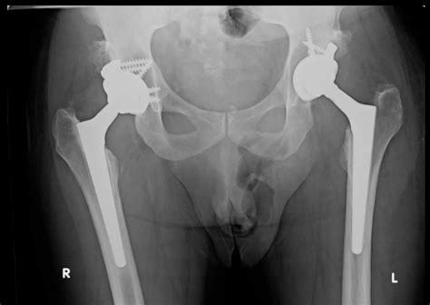 Severe Hip Dysplasia – THA – Darwin Chen, MD