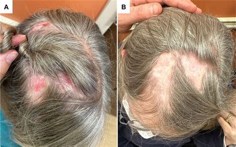 Red, scaly, tender plaques on the scalp (A) in a patient with discoid ...