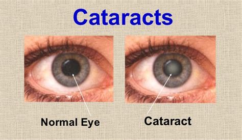 Cataract Eye Treatment - Ahalia Foundation Eye Hospital