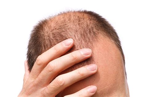 Alopecia Totalis : Overview, Causes, Symptoms, Treatment - illness.com