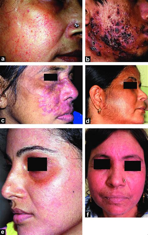 Adverse effects of topical corticosteroids on the face. (a) Marked ...