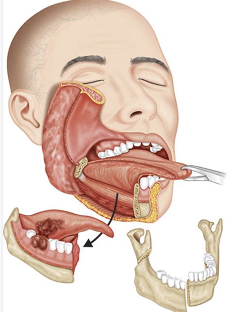 Jaw Cancer Surgery - Renda Clinic