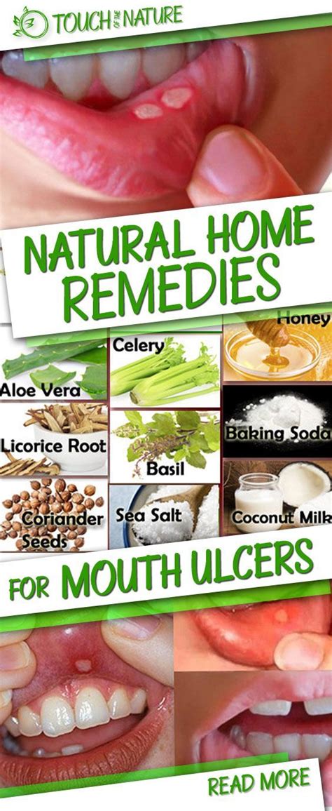 Natural Home Remedies for Mouth Ulcers | Mouth ulcers, Natural home ...