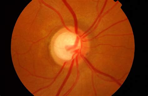 Glaucoma - Miranza