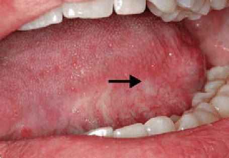 White Spot On Tongue Cancer