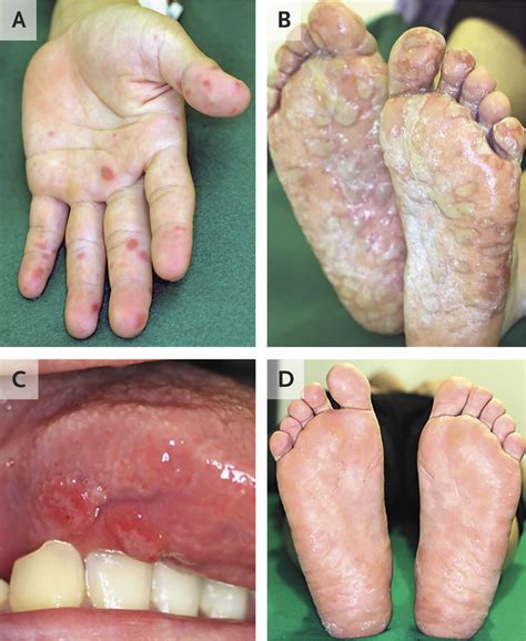 Hand foot and mouth disease, causes, signs, symptoms, diagnosis ...