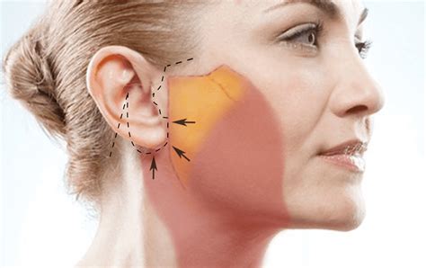 How Visible Are Scars After A Facelift?