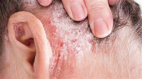 Psoriasis: Síntomas, causas y cómo tratar esta enfermedad de la piel