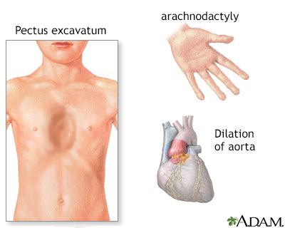 Marfan Syndrome Face