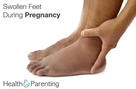 Swollen Feet During Pregnancy - Philips