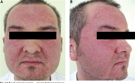 Facial Edema Pictures – Telegraph