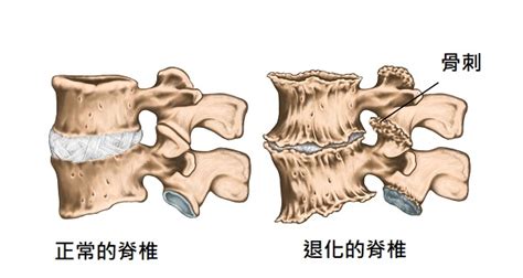 認識小面關節炎及腰椎退化改善方法 » 何琨棟醫師 Dr. Aiden