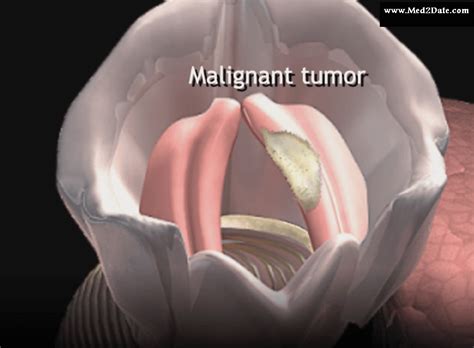 Pathophysiology Of Laryngeal Cancer