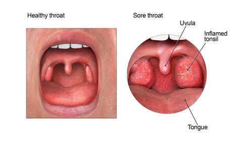 Get Smart About Antibiotics | Sore Throat | CDC