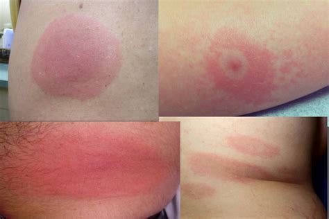 What does a Lyme disease rash look like? - Daniel Cameron, MD, MPH