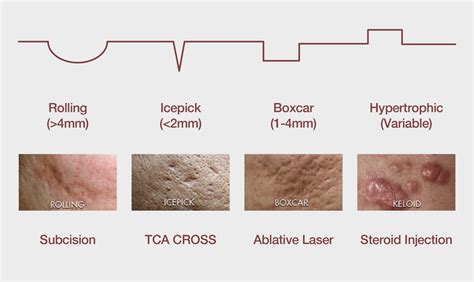 Scar Reconstruction: Treating Skin Scars | Dr Sin Yong